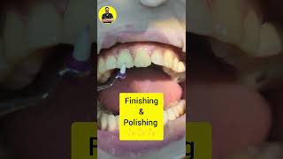 chipped tooth repair front tooth teeth dentist shortsfeed dental [upl. by Ahern945]