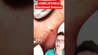 Stunning LIP BLACKHEAD REMOVAL  Biggest Blackheads Ever shorts [upl. by Ayahc]