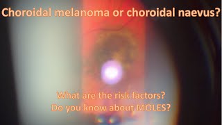 Choroidal melanoma or choroidal naevus [upl. by Ayerhs987]