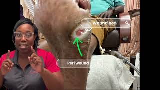 Diabetic Foot Ulcer Debridement Wound bed amp Peri wound explained👣🗣️‼️ [upl. by Larok]