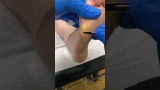 Expert Australian Podiatrist Removes Thick Callus from Forefoot with Precision [upl. by Oicirbaf]