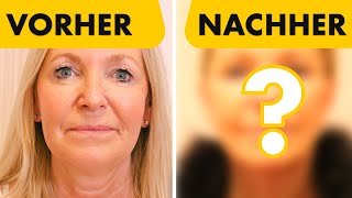 Ich zeige endlich das Facelift Ergebnis meiner 51jährigen Patientin  Dr Jungwirth [upl. by Namso543]