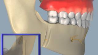 Sagittal Split Osteotomy [upl. by Schober]