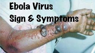 EBOLA VIRUS OUTBREAK Sign amp Symptoms of Ebola Virus Disease [upl. by Ahtaga]