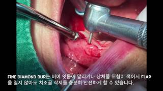 Bur selection tip For alveolopasty and osteoplasty by 드림팩토리치과 [upl. by Lakin154]