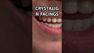 CRYSTALIGN FACINGS NIEUW  😍 [upl. by Dirgni840]