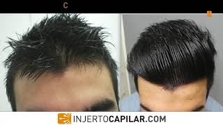 1908 FUE Grafts10 years follow up in young patient 5 small procedures  medical treatment2822009 [upl. by Sancho]