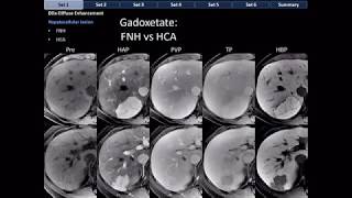 CT Differential Diagnosis of Focal Hepatic Lesions Basic Radiology [upl. by Euqirat]