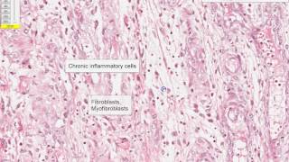 Granulation tissue Microscopy [upl. by Sucramej]