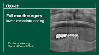 Clinical Case Full mouth surgery lower immediate loading [upl. by Tatiana841]