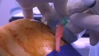 WATCH a Knee Joint Injection  LIVE [upl. by Grassi408]