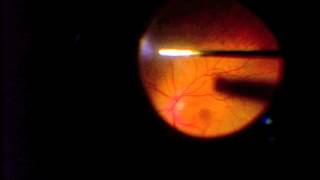 Vitrectomy for Vitreous Opacification FOV [upl. by Ariaec611]