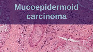 Mucoepidermoid Carcinoma of Salivary Glands  Pathology mini tutorial [upl. by Heyer]