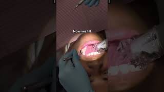 How to do Fillings and Cavities way Faster [upl. by Ettenwahs]