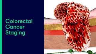 Colorectal Cancer Staging [upl. by Attezi]