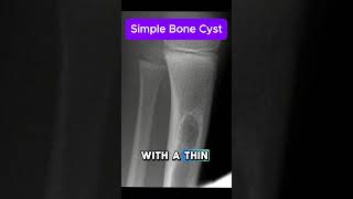 simple bone cysts [upl. by Nyra]