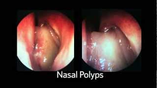 AAOHNSF The ENT Exam Episode 4 The Nasopharynx and Larynx Exam [upl. by Schlesinger]