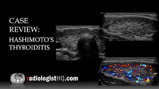 Ultrasound of Hashimoto’s Thyroiditis [upl. by Hnad]