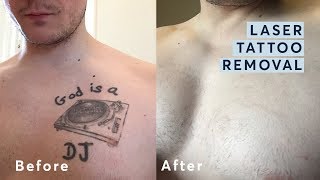 Laser Tattoo Removal  Before and After through all the stages [upl. by Ocihc]