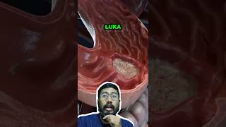 Proses terbentuknya luka di lambung apa sebabnya ulkuslambung gastritis youtubehealth [upl. by Aggappera680]