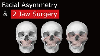 Correcting facial asymmetry with bimaxillary 2 jaw surgery [upl. by Bobbie]