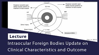 Intraocular Foreign Bodies Update on Clinical Characteristics and Outcome [upl. by Lleinad186]