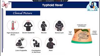 Practical Diagnosis of typhoid fever plague undulant fever [upl. by Lynden298]