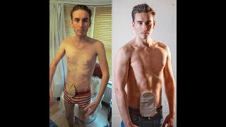 My Survival Story  Living With An Ileostomy Bag [upl. by Hartnett]