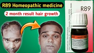 R89 Homeopathic medicine 2 month result hair growth treatment [upl. by Gonzalez]