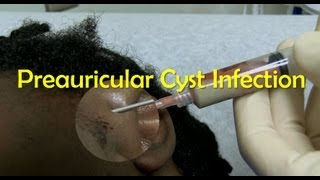 Preauricular Cyst Infection Management [upl. by Gillead]