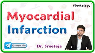 4 Myocardial Infarction Heart Attack  Pathology USMLE Step 1 [upl. by Vanessa]