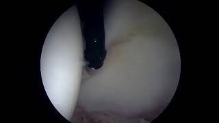 Debridement of Hyperplastic Labrum Prior to Surgical Repair [upl. by Yasnyl175]