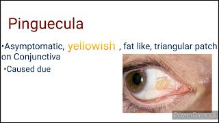 Pinguecula  Pterygium  short notes and differential diagnosis  Conjunctiva [upl. by Bouldon]