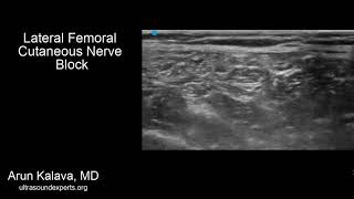 Lateral Femoral Cutaneous Nerve Block [upl. by Nawotna453]