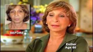 Patient Testimonial Lifestyle Lift Patient Esther [upl. by Arva]