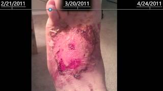 2nd Degree burns on foot  healing time lapse  2 months [upl. by Ellinej744]