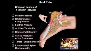 Heel Pain causes and treatment plantar fasciitis diagnosis and treatment [upl. by Yojenitsirk]