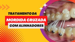 TRATAMENTO DA MORDIDA CRUZADA COM ALINHADORES [upl. by Annoyek]