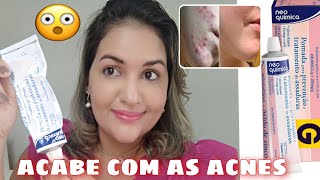 Pomada Nistatina com óxido de zinco para acabar com ACNES e MANCHAS  respondendo inscritos [upl. by Cormick]