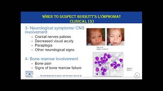 Diagnosis and Referral of Burkitt’s Lymphoma – 3 February 2023 [upl. by Mraz]