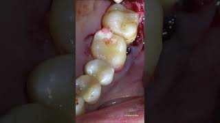 Tooth autotransplantation 28 to 26 endodontictreatment autotransplantation dentistry [upl. by Bock875]