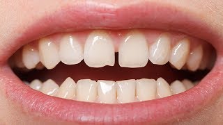 Geralmente Quanto Tempo Dura uma Prótese Dentária de Silicone Removível Qual Tempo de Durabilidade [upl. by Odnomor]