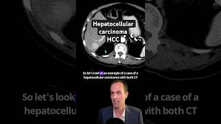 Abdominal CT Tutorials  Hepatocellular carcinoma HCC [upl. by Rede]