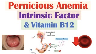 Pernicious Anemia Rare Cause of Vitamin B12 Deficiency  Causes Symptoms Diagnosis Treatment [upl. by Noit12]