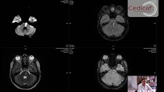 Caso Clínico Micro angiopatia Cerebral Infartos Lacunares Multiples Dr Jorge Ivan Ospina [upl. by Honora180]