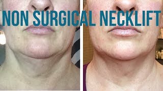 NECK LIFT RESULTS Fibroblast Aftercare amp New Korean Powerhouse Antiager [upl. by Notna]