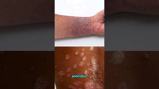 Eczema vs Psoriasis healthwise shorts medical [upl. by Akemrej14]