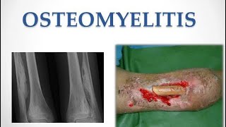 Bone and Joint Infection  Osteomyelitis  Medicine  MisMedicine [upl. by Euhsoj667]