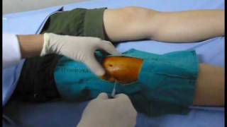 Knee aspiration technique Knee synovitis เจาะเข่า เข่าอักเสบ [upl. by Ydrah904]