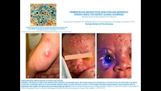 HUMAN M pox Monkeypox Infection And Morbidity Persist Since The Recent Global Outbreak [upl. by Attiuqaj]